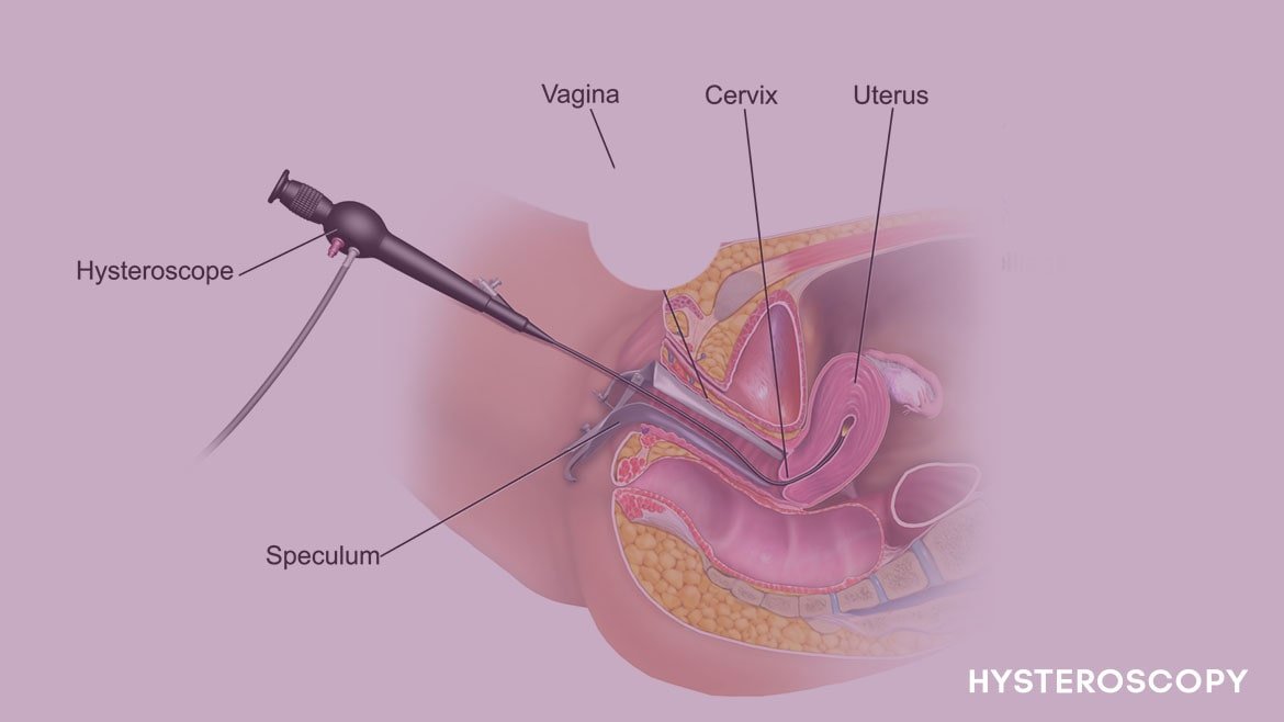 Hysteroscopic PRP